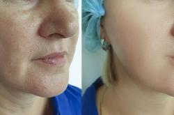 赤峰激光祛魚尾紋醫(yī)院電話號碼