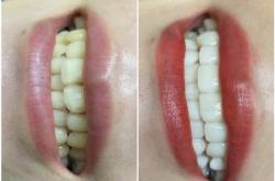 赤峰市牙齒瓷貼面店電話號碼