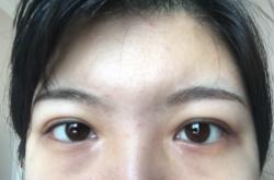 赤峰開眼角醫(yī)生電話號(hào)碼是多少