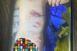 赤峰市狗咬傷醫(yī)院電話號碼