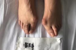 赤峰大腳骨治療醫(yī)院