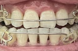 赤峰矯正大舌頭醫(yī)生電話號碼