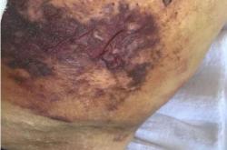 赤峰專業(yè)祛疤店地址電話號(hào)碼