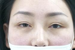 赤峰做雙眼皮醫(yī)院簡介電話號碼