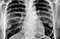 赤峰市醫(yī)院胸透科電話號碼是多少