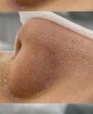 赤峰清理黑頭電話多少錢啊