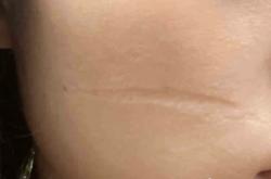 赤峰市無痕修復(fù)公司電話號碼