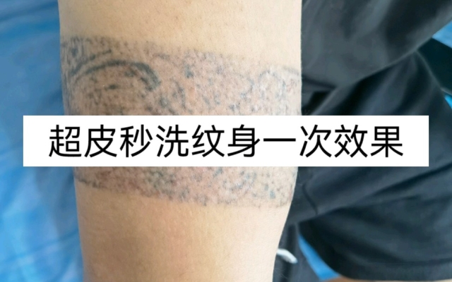 赤峰超皮秒紋身店地址電話號碼-第1張圖片