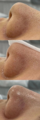 赤峰清理黑頭電話多少錢啊-第1張圖片