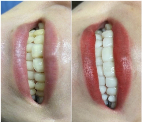 赤峰市牙齒瓷貼面店電話號碼-第1張圖片