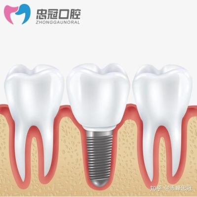 赤峰種牙推薦醫(yī)生電話是多少號-第1張圖片