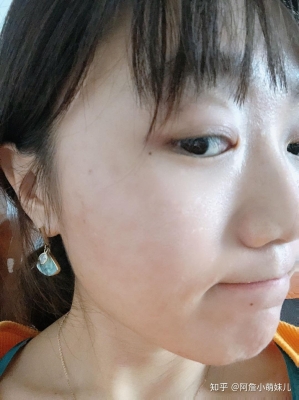 赤峰針清祛痘團(tuán)購(gòu)電話-第1張圖片