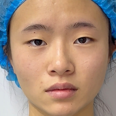 赤峰市雙眼皮-第1張圖片