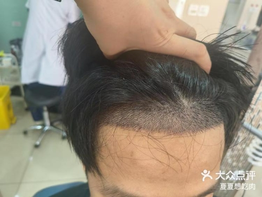 赤峰有幾家植發(fā)醫(yī)院啊電話號(hào)碼-第1張圖片