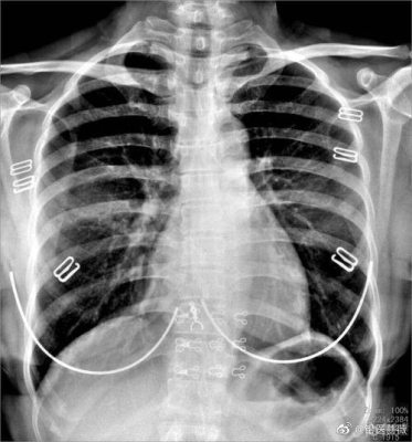 赤峰市醫(yī)院胸透科電話號(hào)碼是多少-第1張圖片