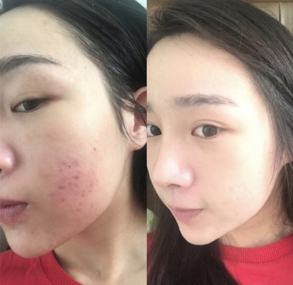 赤峰針清祛痘店地址電話號碼-第1張圖片