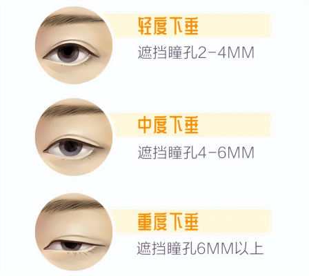 做上瞼下垂哪個(gè)醫(yī)院好-第1張圖片