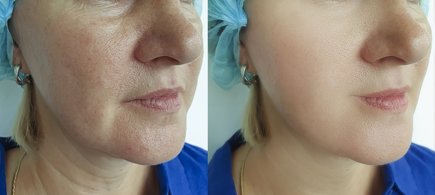 赤峰激光祛魚尾紋醫(yī)院電話號(hào)碼-第1張圖片