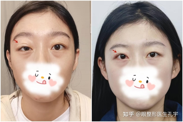 赤峰上瞼下垂醫(yī)院電話地址是多少-第1張圖片