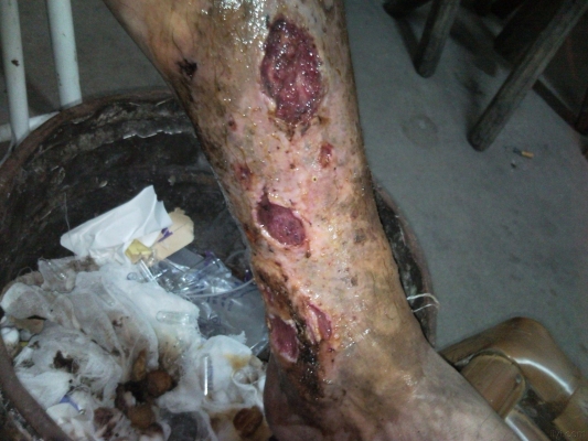 赤峰老爛腿治療中心電話號碼-第1張圖片