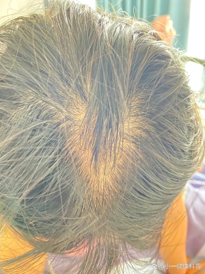 赤峰醫(yī)院脫發(fā)門診電話號碼是多少-第1張圖片