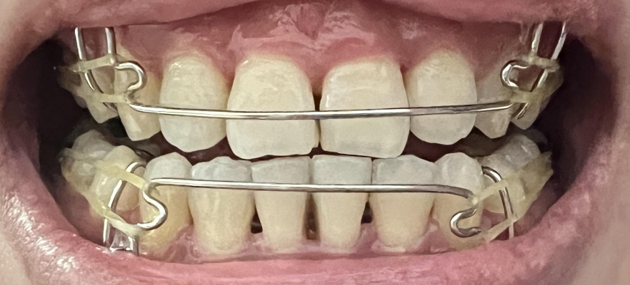 赤峰矯正大舌頭醫(yī)生電話號碼-第1張圖片