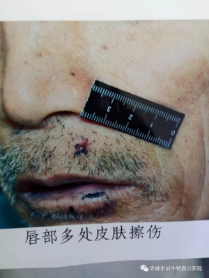 赤峰市法醫(yī)鑒定電話號碼-第1張圖片