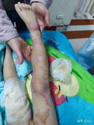 赤峰市燙傷科醫(yī)院電話號(hào)碼-第1張圖片