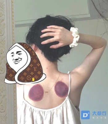 赤峰拔火罐團(tuán)購(gòu)地址電話號(hào)碼-第1張圖片