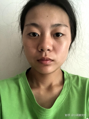 赤峰附屬雙眼皮醫(yī)生電話號碼-第1張圖片